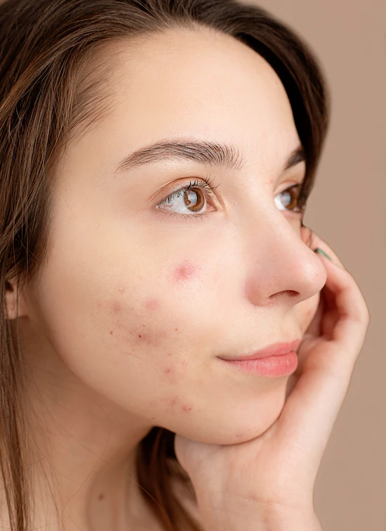 Akne Behandlung bei Beauty Accent Kosmetik